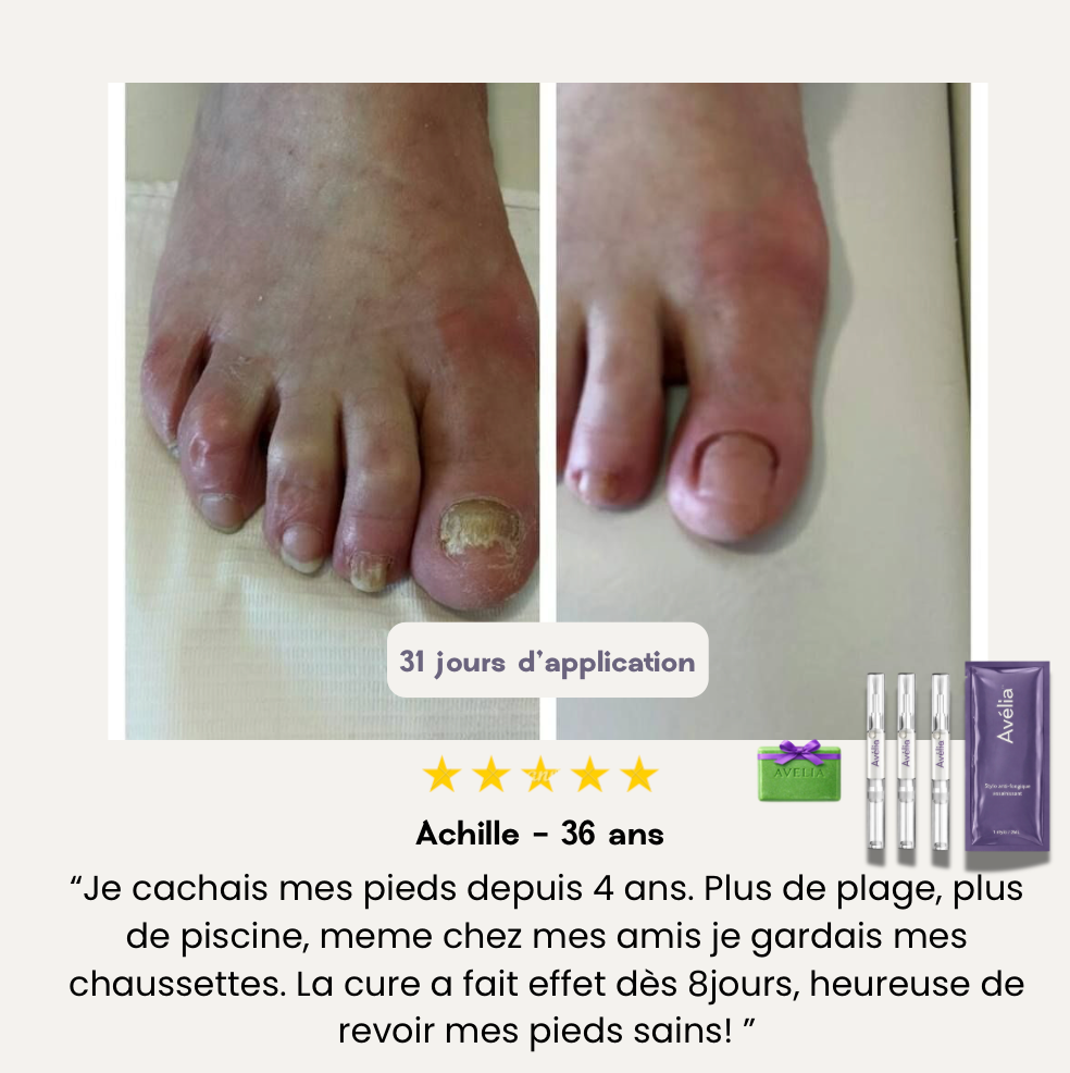 Mycose des ongles : traitement rapide pour oser enlever ses chaussures | Avélia
